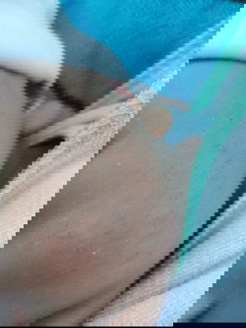 แก้มลูกแบบนี้เป็นอะไร ?