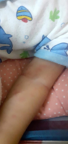 น้องมีผื่นขึ้นค่ะ