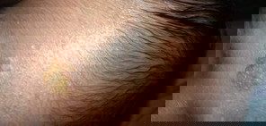 Ano po kaya itong nsa noo ni baby?