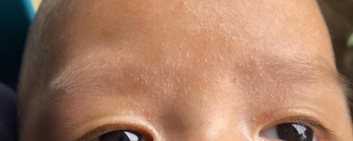 Cradle cap