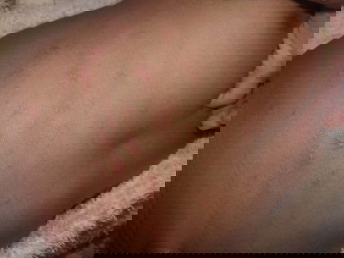 พุงลูกเป็นเม็ดเกิดจากอะไรค่ะใครรู้บ้างเป็นหลายวันแล้ว