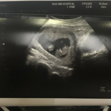 มีแม่ท่านไหนท้องแล้วเด็กเสียชีวิตในครรภ์บ้างคะ มีโอกาศที่หมออาจจะดูผิดบ้างไหมคะ