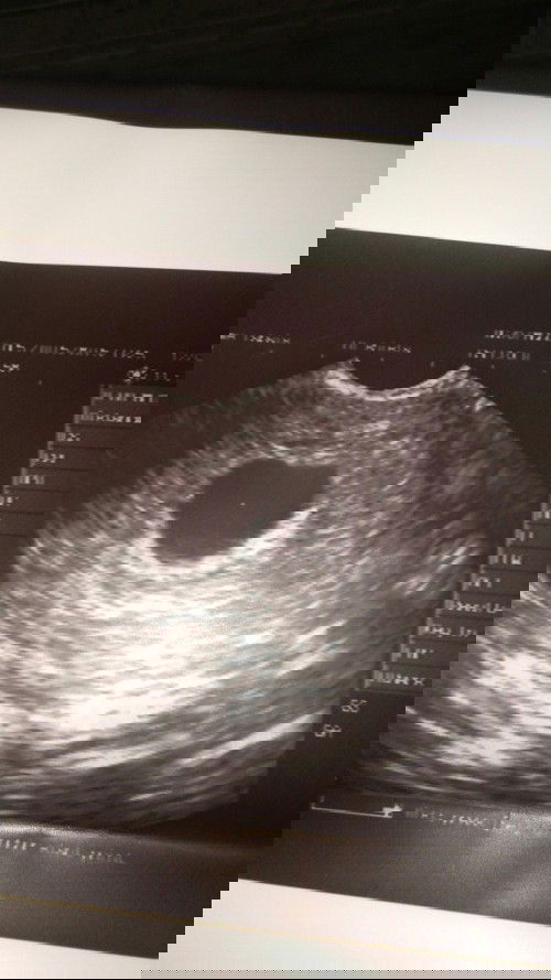 Trans vaginal aultrasound