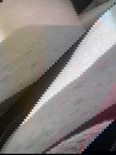 มีใครเคยเป็นผื่นตั้งครรภ์ใกล้จะคลอดบ้างคะ