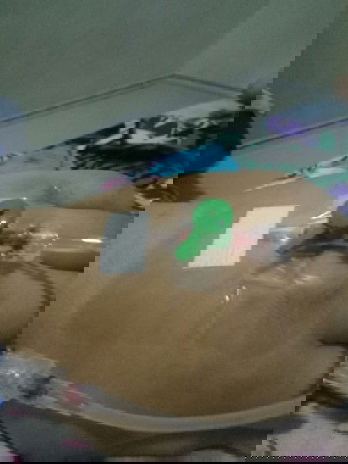 Pre eklampsi berat dtg kepada ku