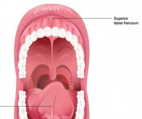 Anak jatuh dan frenulumnya sobek