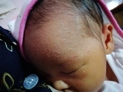 Newborn skin problem