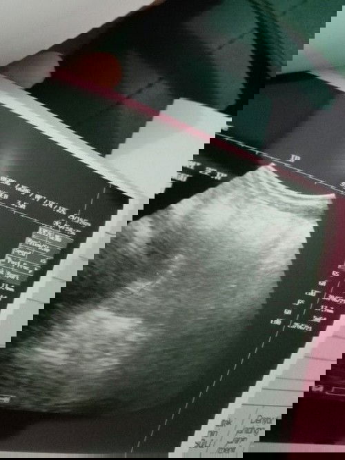 Sudah ada janin, tp tidak berkembang