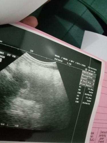 Sudah ada janin, tp tidak berkembang