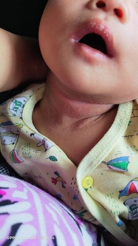 Bund bund mau nanya apakah ini biang keringat?atau apa?sharing obatnya ya..