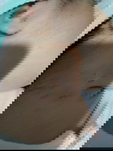 BABY NECK RASH