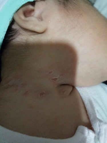 BABY NECK RASH