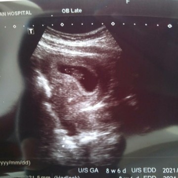 ซาวน์ครั้งแรกเจอแต่ถุง แต่ครั้งที่2เจอเป็นก้อนแล้ว