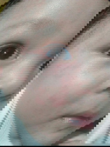rashes