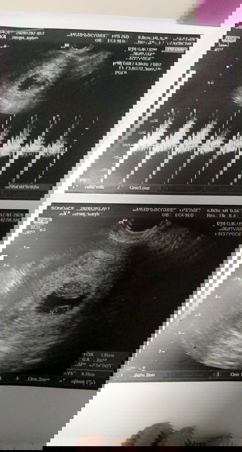 Hi to all mommy ask q lng poh cno marunong 2mingin ng ultrasound pic..ok lng kya baby q?