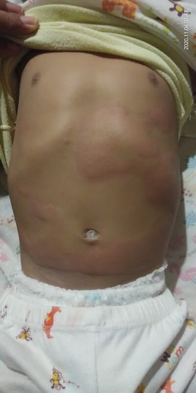 Alergi/biduran pada bayi