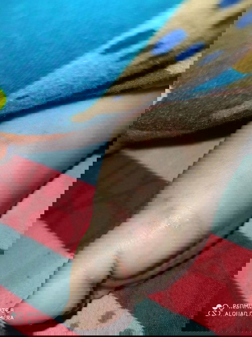 Gatal di kaki dan ketiak bayi