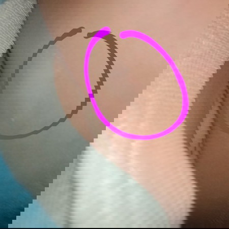 Mga Mommy ano po itong nasa my baba po Ng pisngi ng baby ko puti po na may namalat malay po s gilid