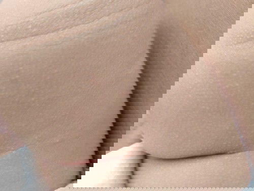 แบบนี้น้องเป็นผดอะไรคะ