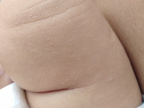 แบบนี้น้องเป็นผดอะไรคะ