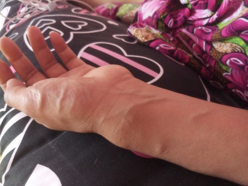 pergelangan tangan bengkak