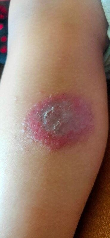 Eksim Atopik/Dermatitis Atopik