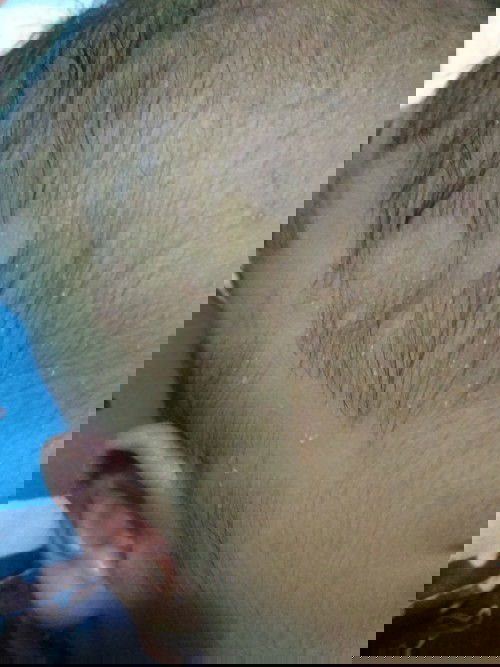 seperti biang keringat tpi berair