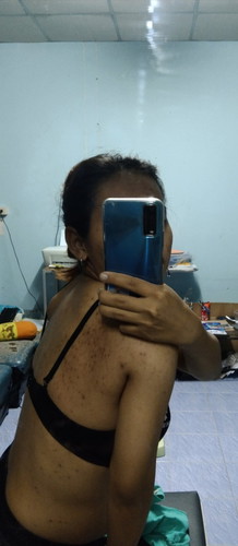 แม่คนไหนสิวเห่อสิวขึ้นบ้างค่ะ