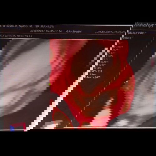 Hpl ikut USG atau HPHT?