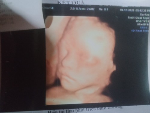 Các mom cho em hỏi
Bầu 7 tháng bé đc 1kg có nhẹ quá ko ạ