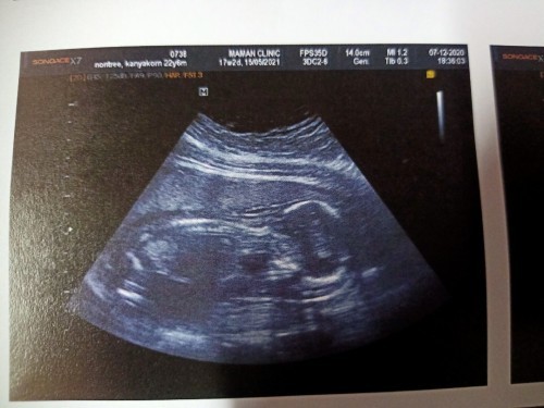 อัตราซาวด์ครั้งแรกคะ