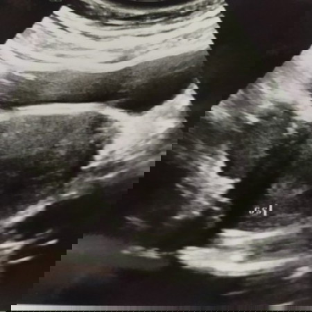 วันนี้มาซาวด์กับคุณหมอตรวจพบเนื้องอกที่มดลูกและซีสต์ที่ปีกมดลูกด้านซ้าย