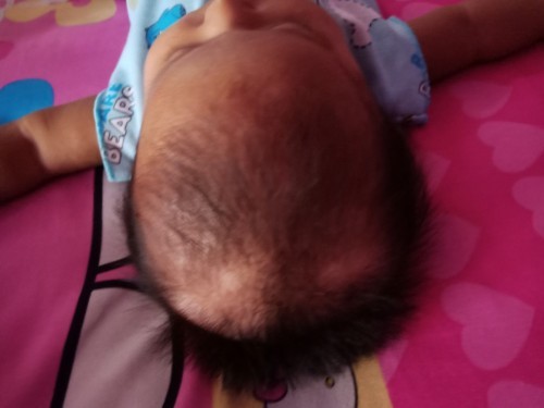 Rambut rontok dan ruam pipi akibat asi