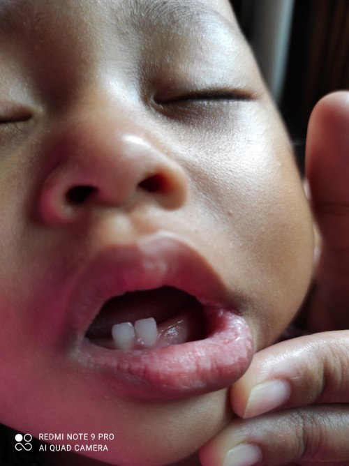 Bibir bayi