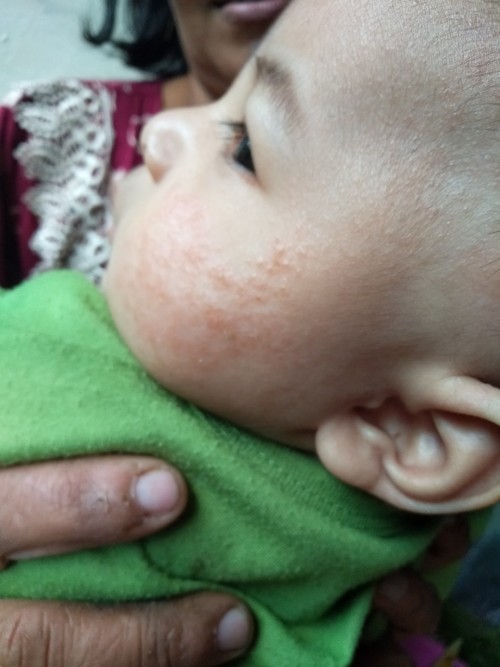 Dermatitis Otopik