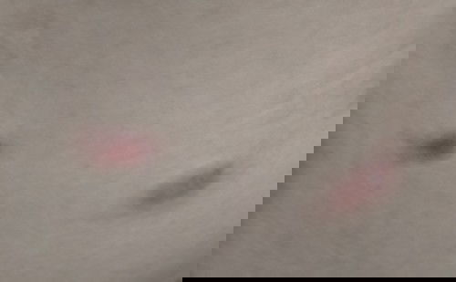 Bumil trimester pertama kenapa kok gatel gatel ya? Ada yang sama?