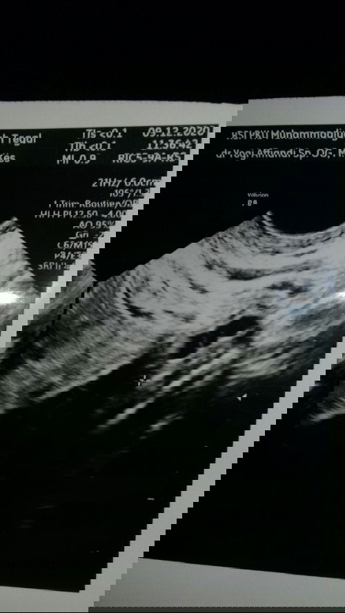 Pcos apakah bisa hamil