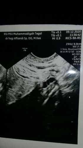 Pcos apakah bisa hamil