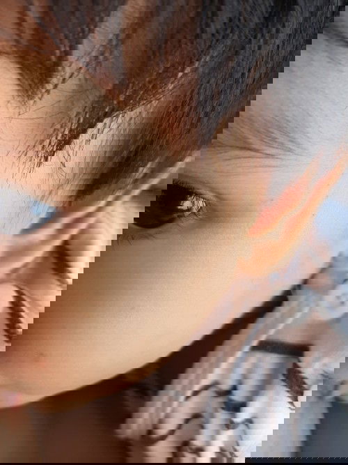 น้องเป็นตุ่มหัวสีน้ำตาลแข็งๆขึ้นที่แก้มและข้างๆแก้มลามไปหางตา อยากถามว่ามีบ้านไหนเคยเป็นแบบนี้มั้ยคะ