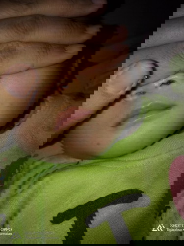 Biang keringat atau alergi