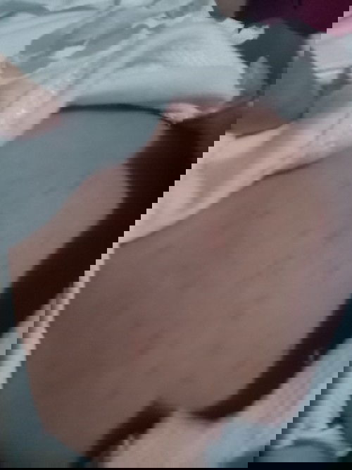 red spots sa tyan ni baby