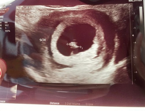 Pendarahan dekat rahim (sch)