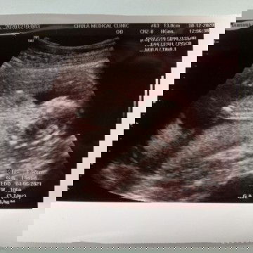 ตั้งครรภ์14วีค