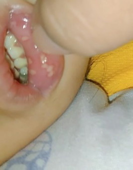 1 week ng singaw ni baby, 2 yrs old na po xa