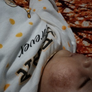 Solusi nya dong Bun 😣 udah pakai VCO masih begitu aja
Yg pernah ngalamin jg bisa hilang berapa lama