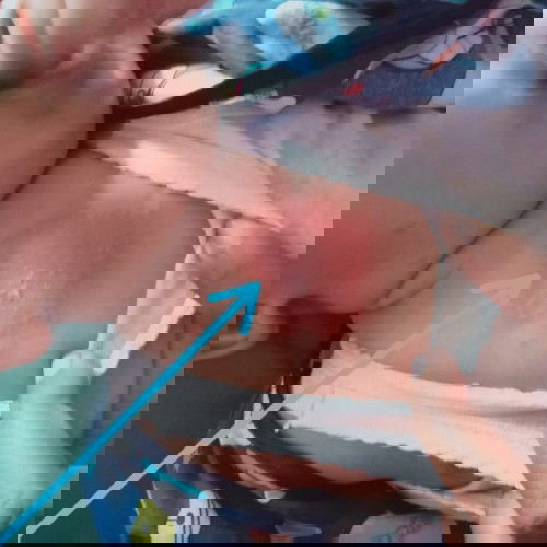 Dada merah seperti kena air panas