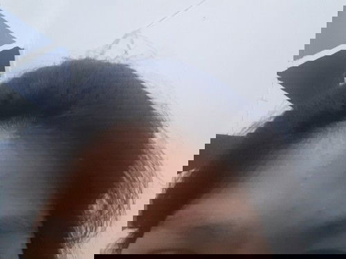 สิว 💧( แม่หลายๆคน)🤰