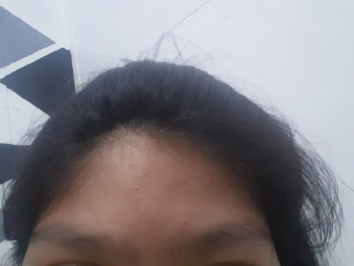 สิว 💧( แม่หลายๆคน)🤰