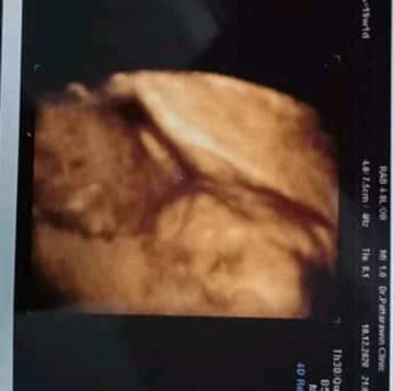 หมอบอกว่ามีดั้ง55555