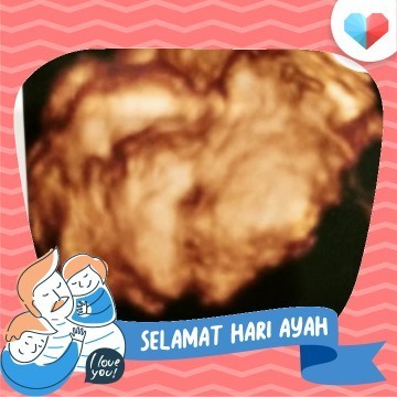 Kehamilan 37 week